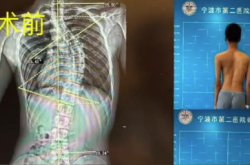 男孩脊柱扭成S形背部植入18颗螺钉